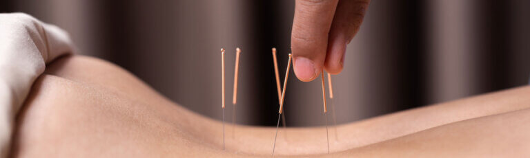 Traditionelle Chinesische Medizin (TCM) in Oerlikon | Akupunkturbehandlung einer Patientin am Rücken
